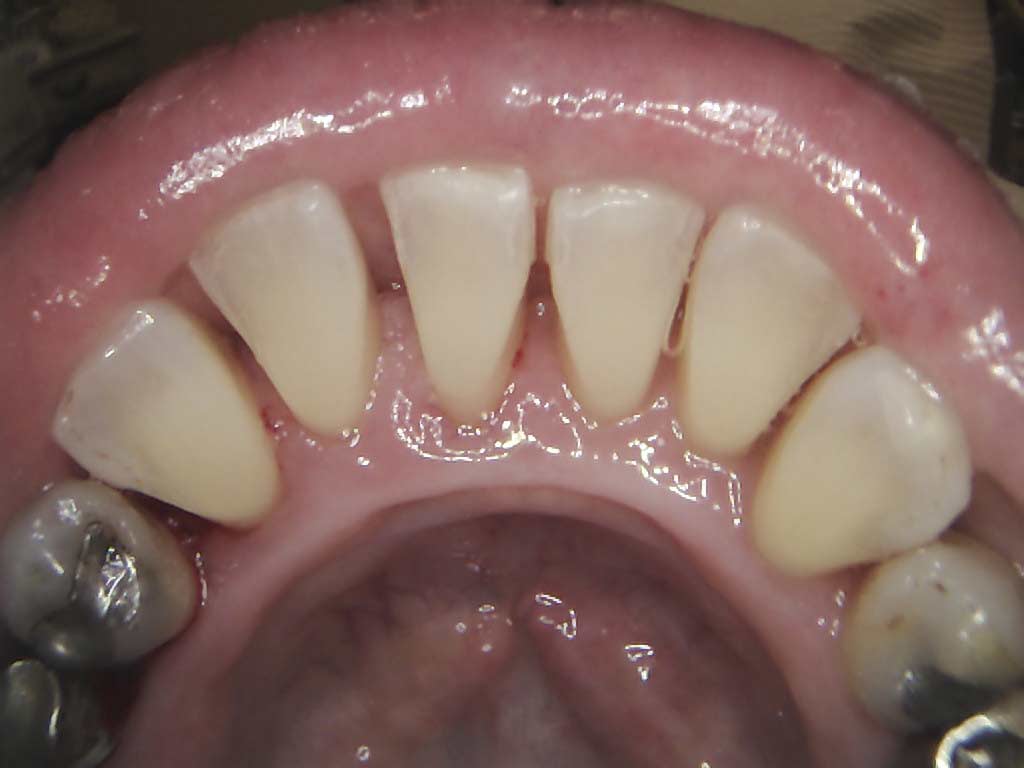 Pink and healthy gum tissues after periodontal treatment